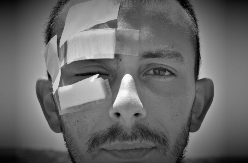  Profesor Matías Orellana perdió un ojo tras recibir disparo de bomba lacrimógena en Valparaíso